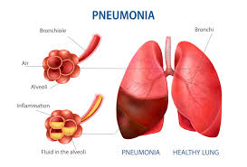 Pneumonia: Dari Asal Usul Hingga Cara Pulih dengan Pola Konsumsi Sehat